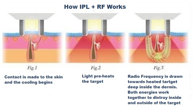 how-RF-Plus-ipl-works